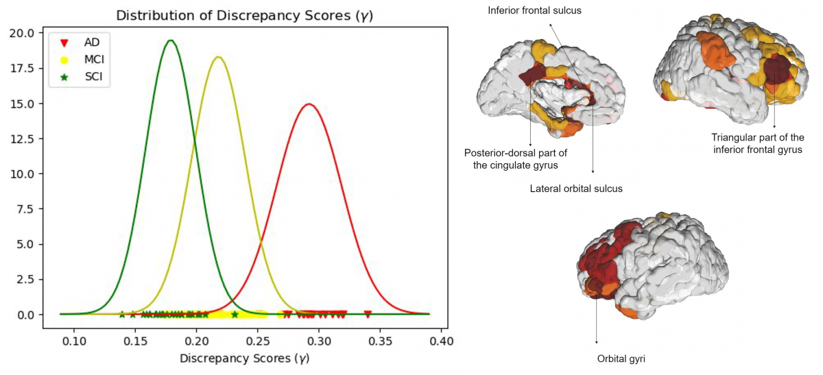 Distribution of structure-function discrepancy scores and prominent brain regions.